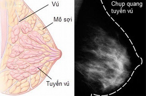 Nổi u hạch ở nách: Cảnh giác ung thư vú